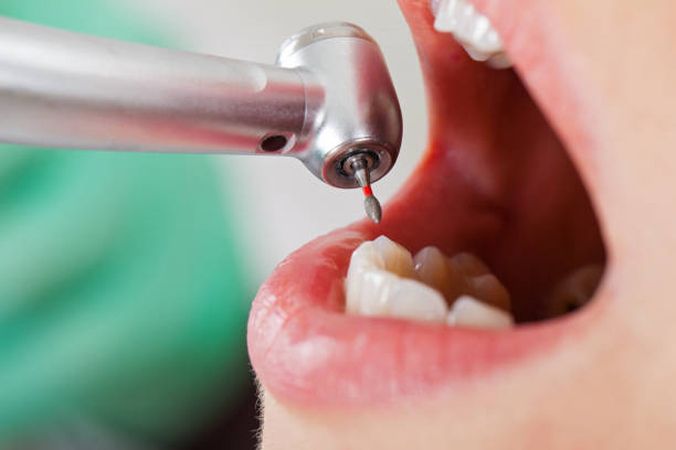 Best Emergency Dentist for Lost Fillings or Crowns in Savannah, GA